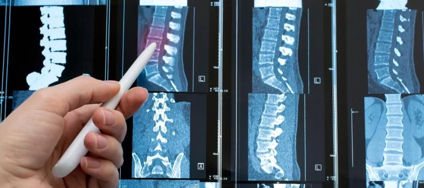 4 long-term complications of spinal injuries-image